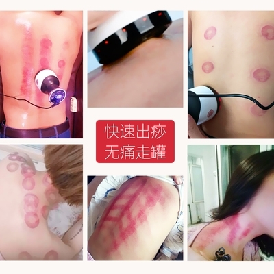艾灸拔罐一體罐與電動刮痧儀 傳統養生與現代科技的完美融合
